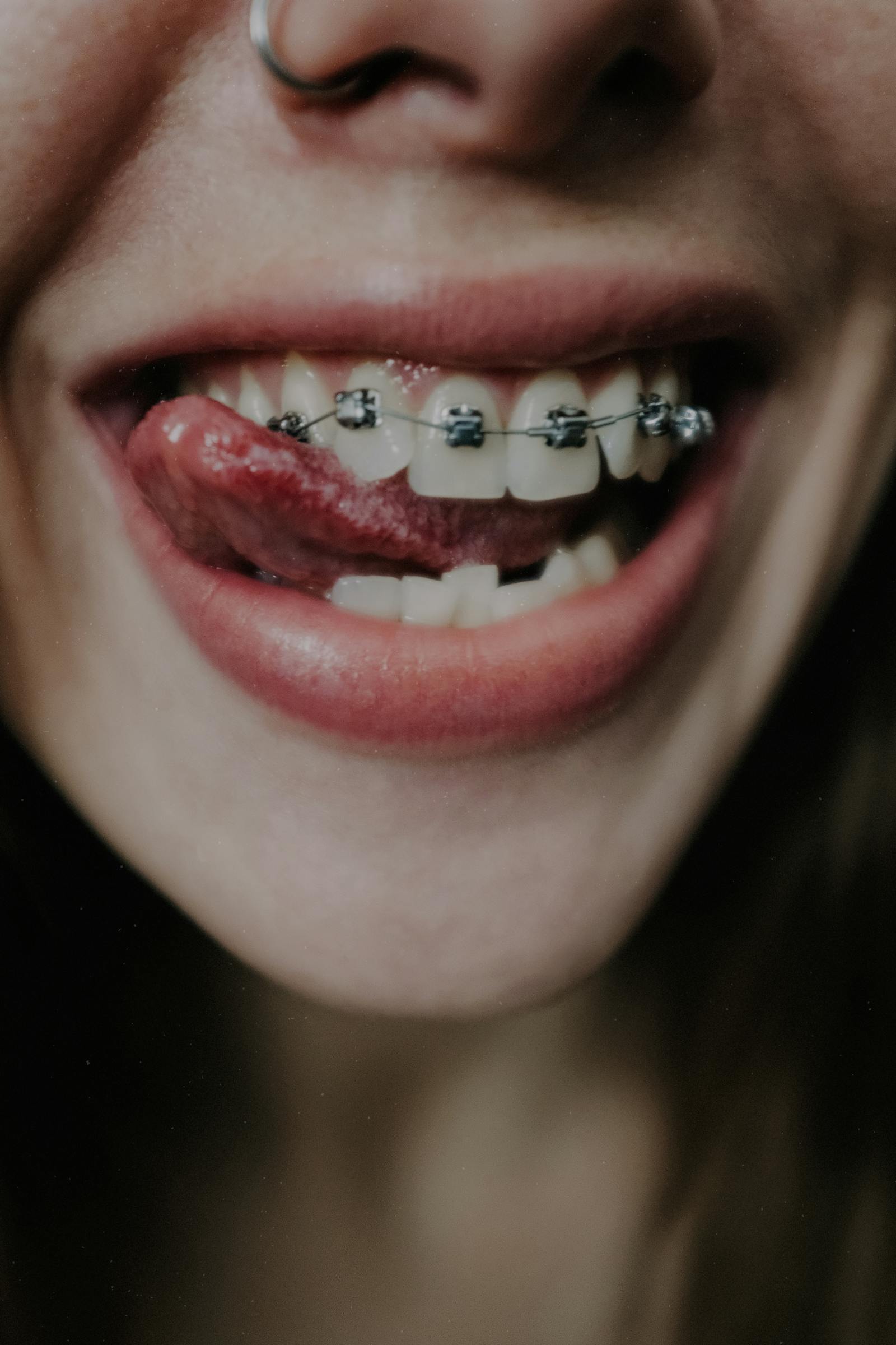 Simple Braces (Metal)