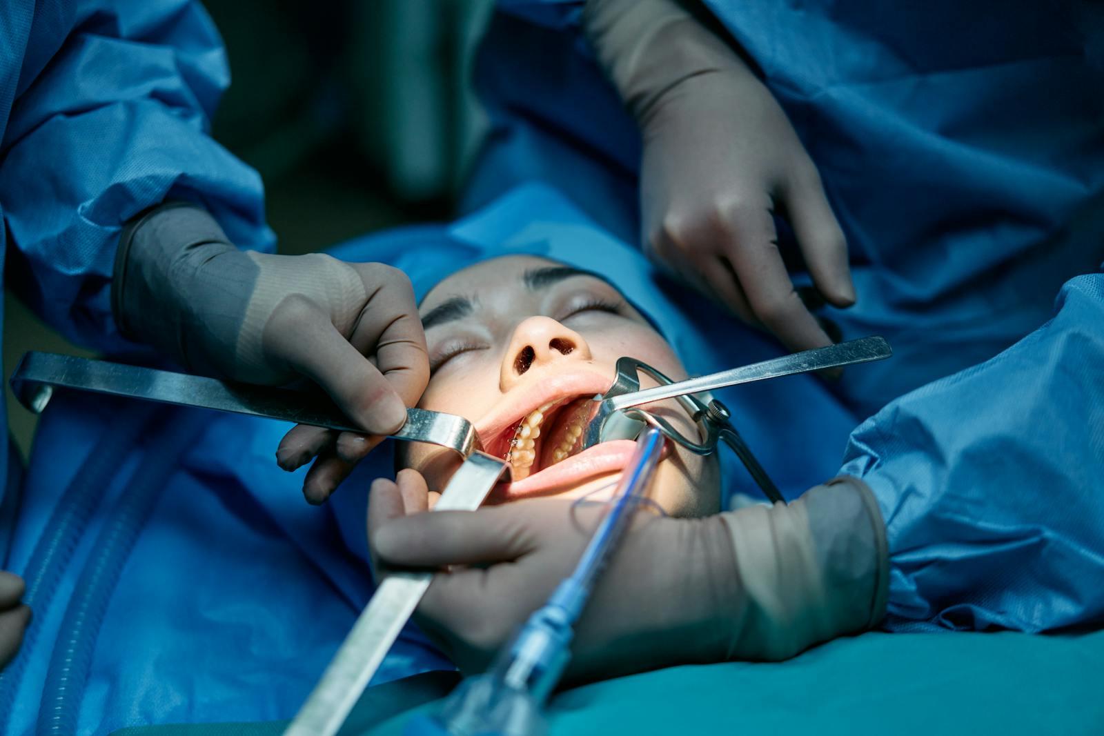 Peri-implant Soft Tissue Grafting