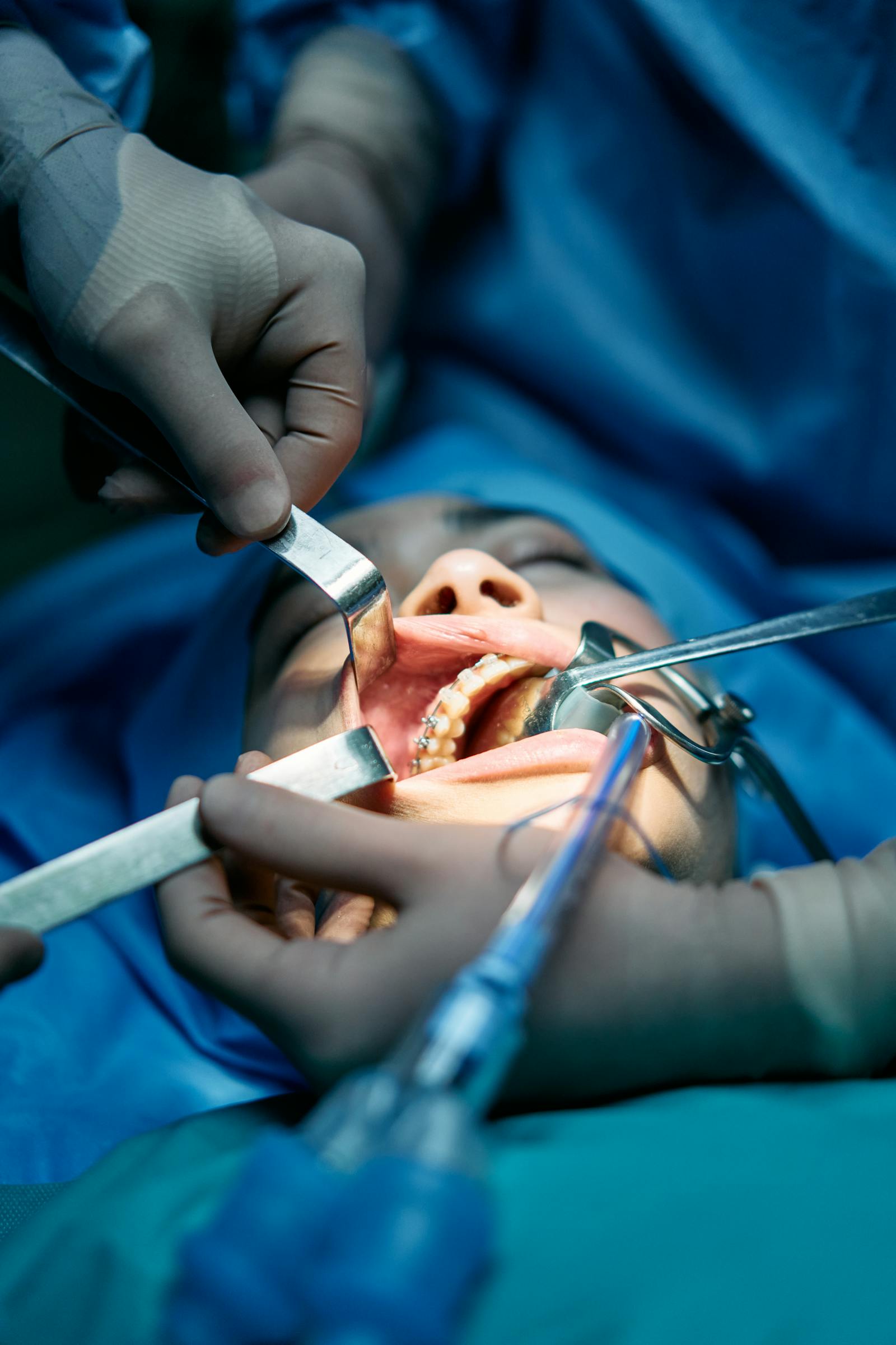 Sinus lifting (hissəvi)