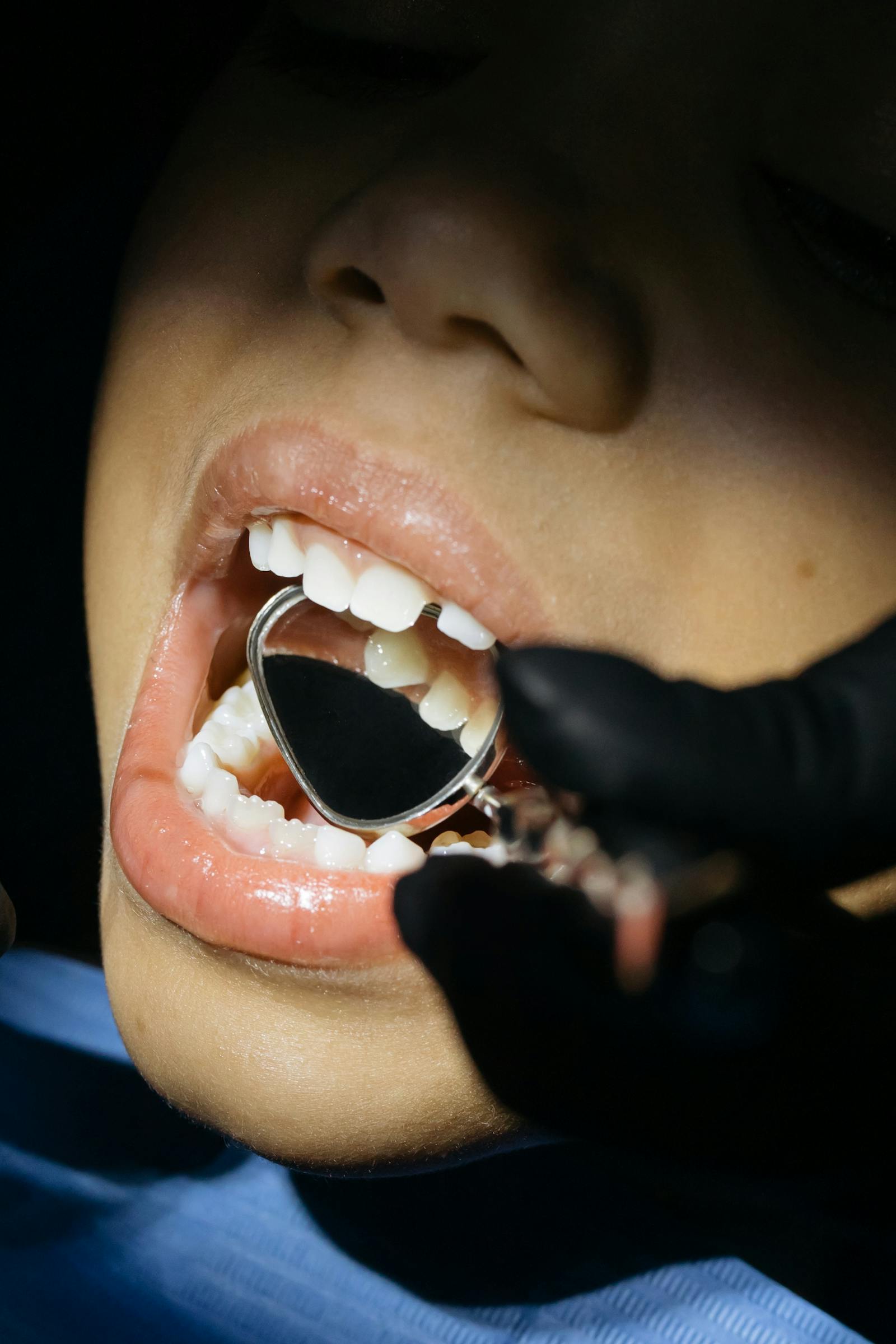 Pediatric Root Canal Treatment