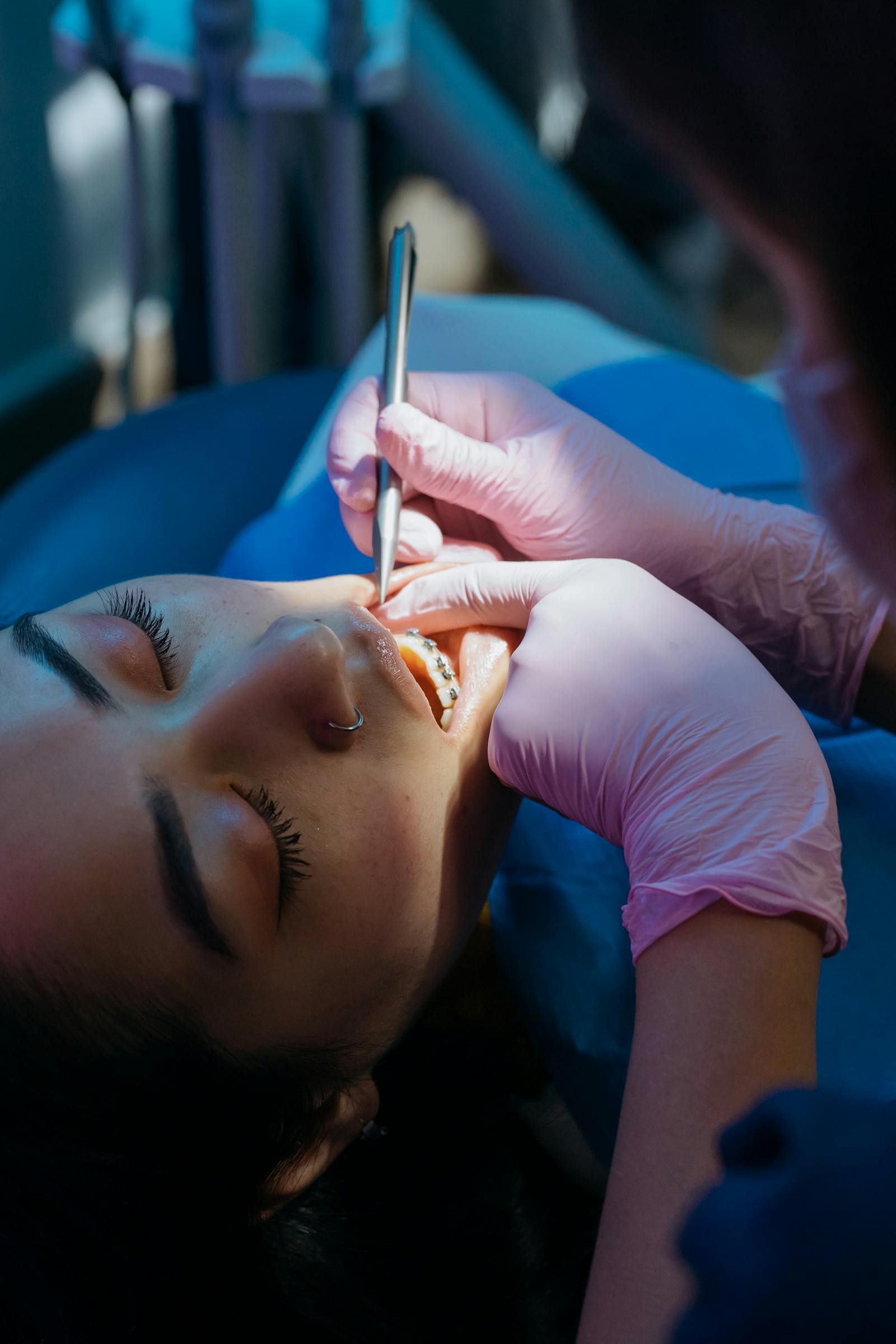 Pericoronitis Treatment