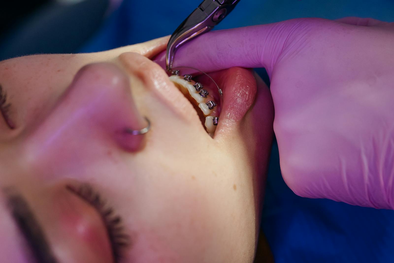 Orthodontic Mini Implant