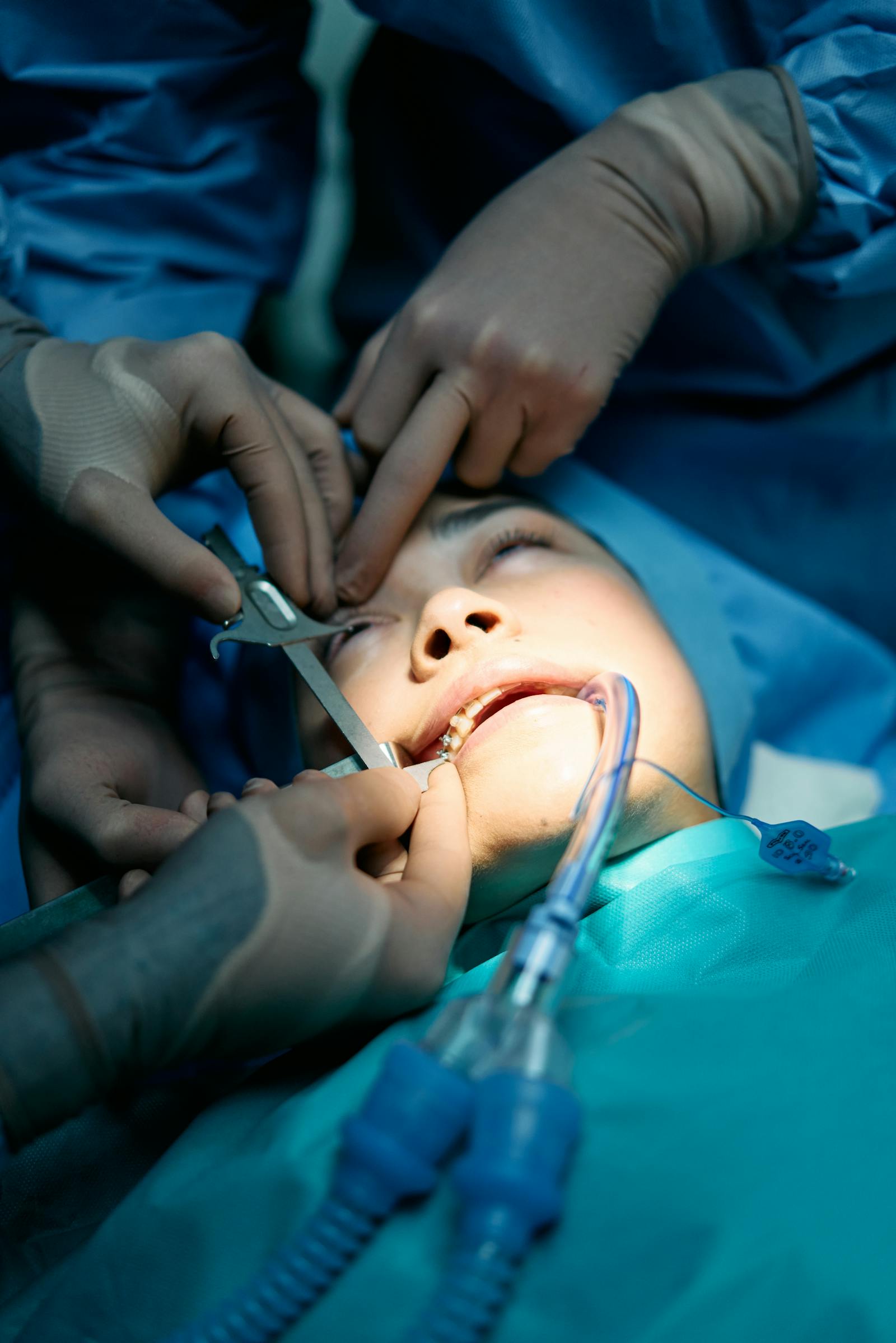 Bilateral Sinus Lift