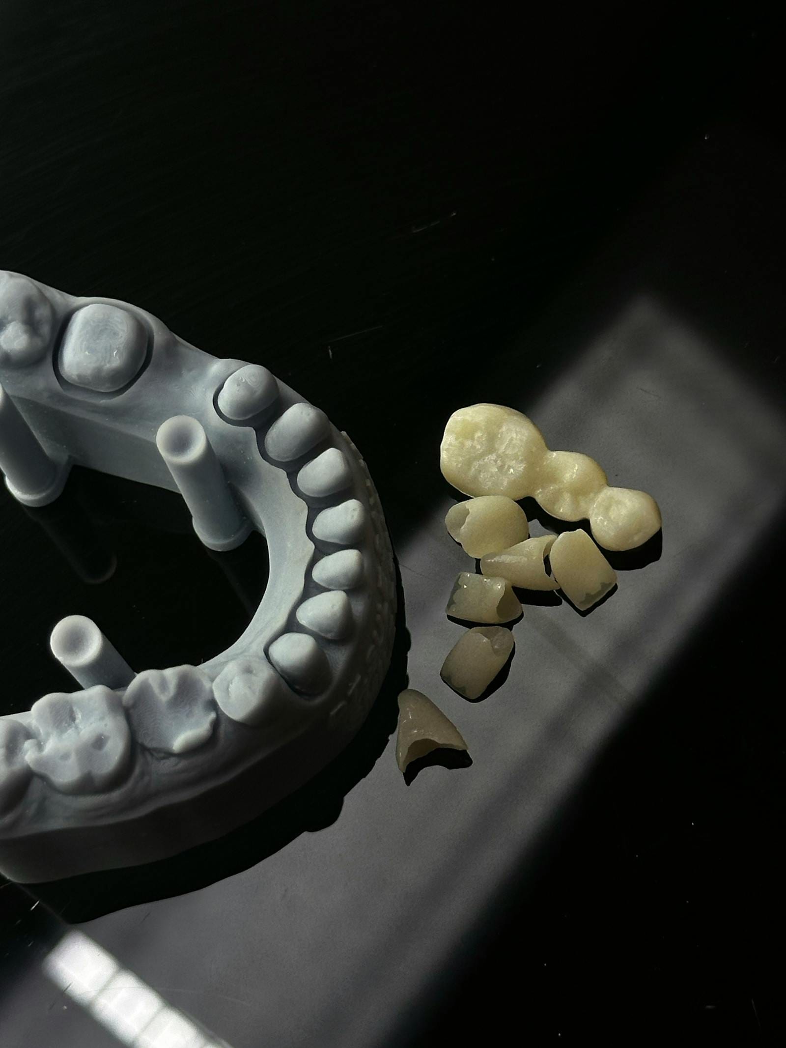 Zirconia Crown (E-max)