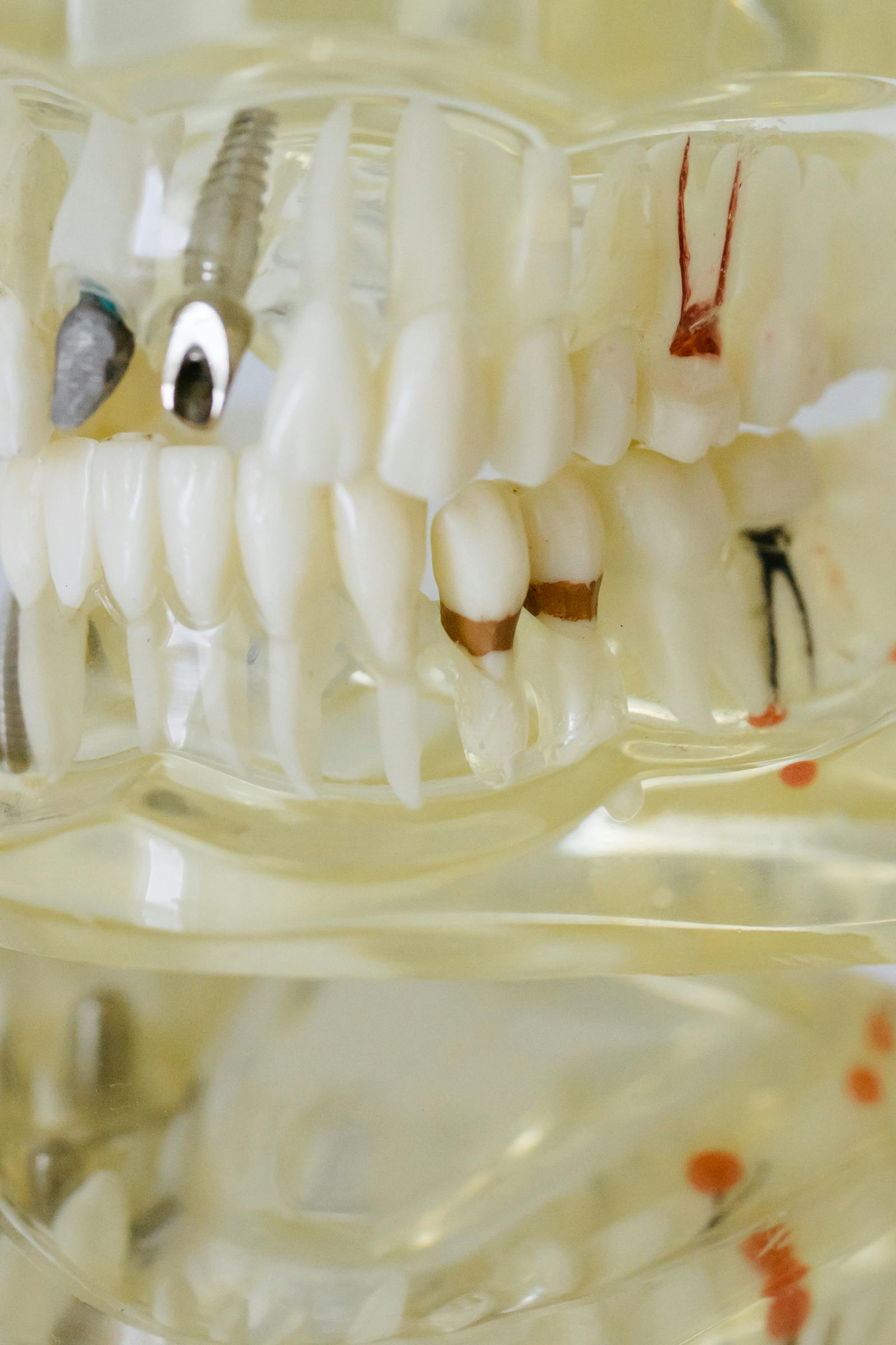 Biotem Implant