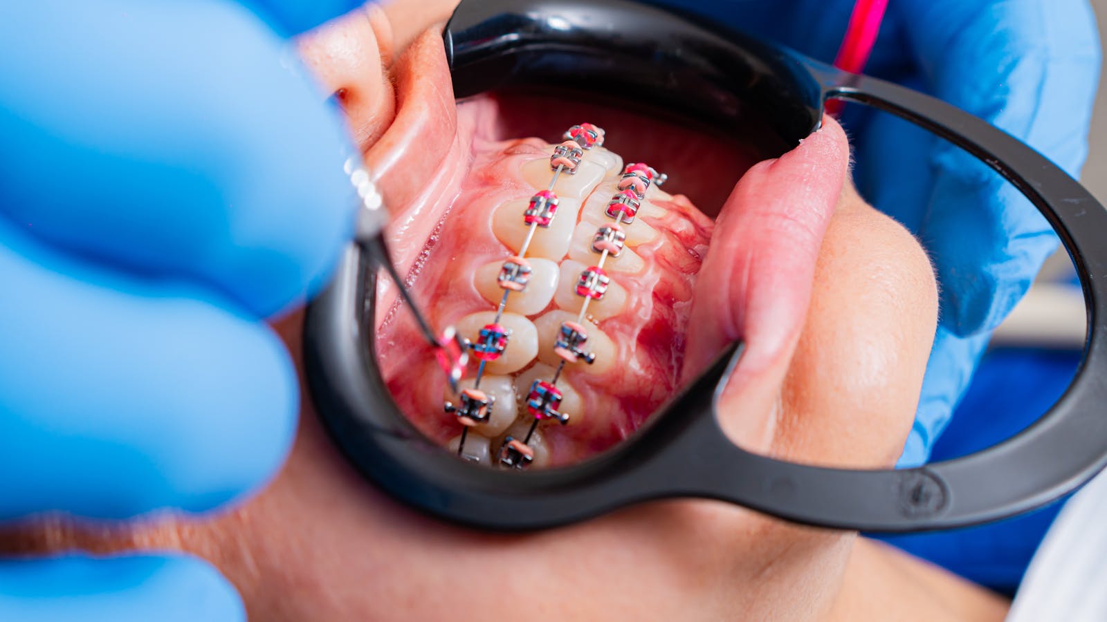 Complex Braces (Ceramic / Self-Ligating)