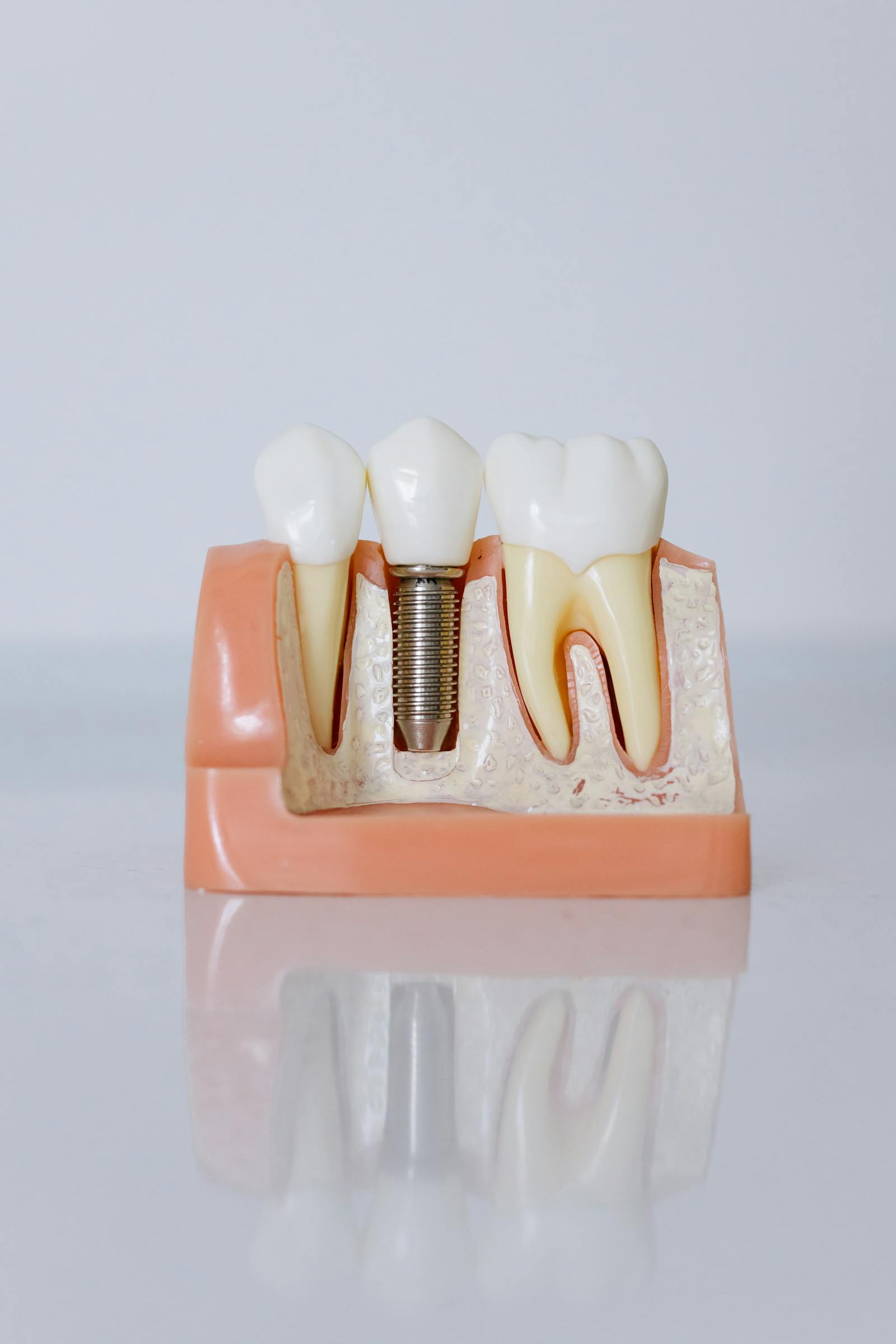 Biotech Implant (France)