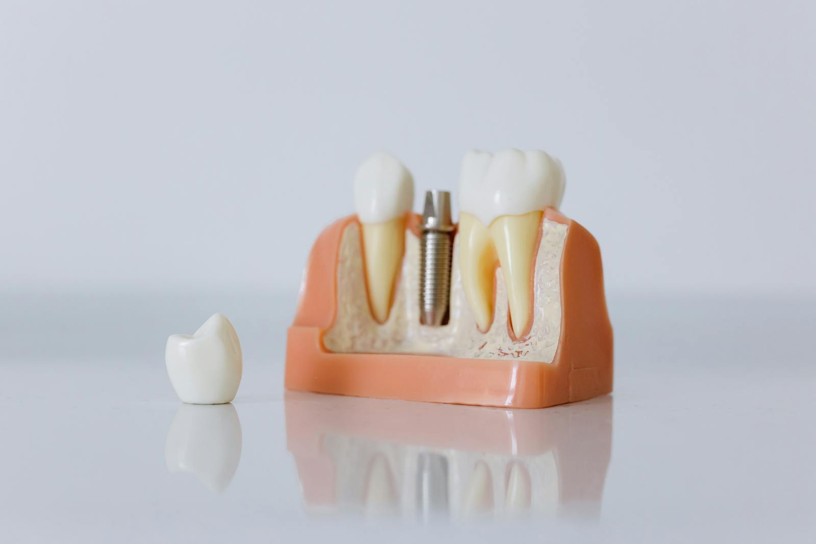 AnyRidge Megagen Implant (Korea)