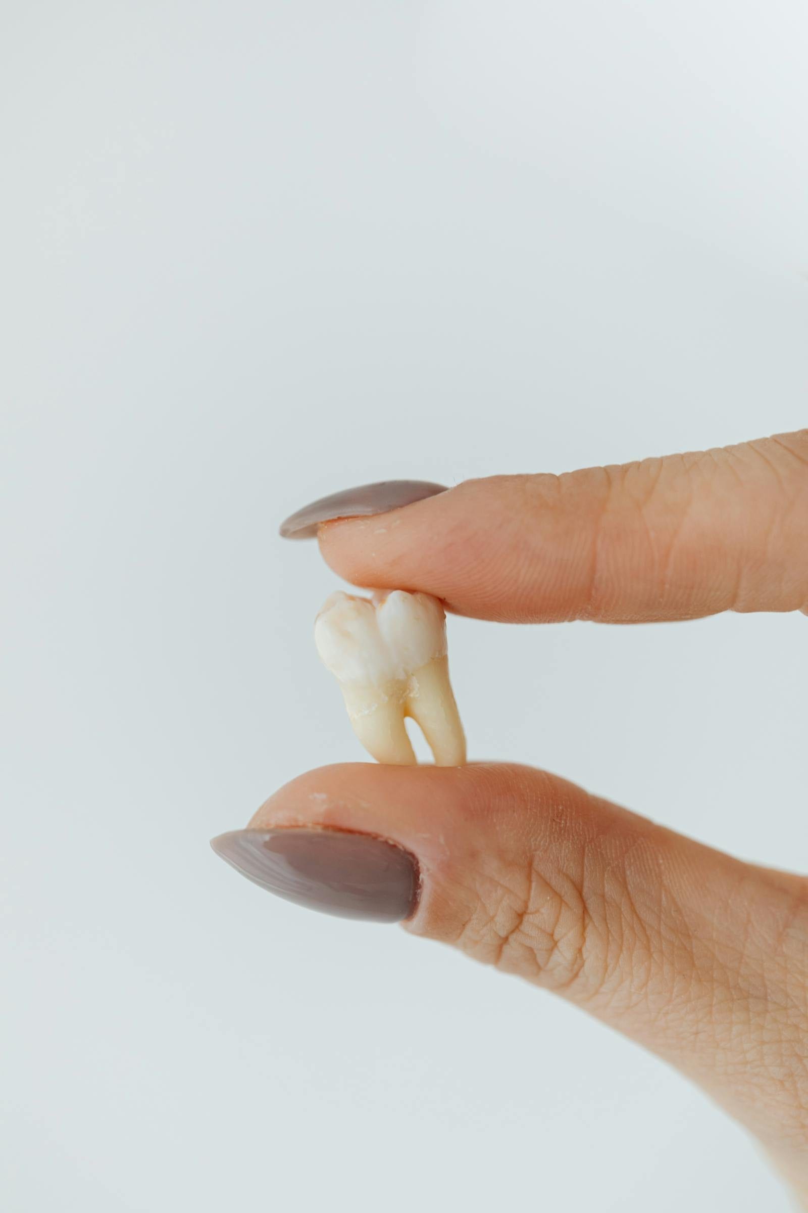 Full Bone-Impacted Wisdom Tooth Extraction