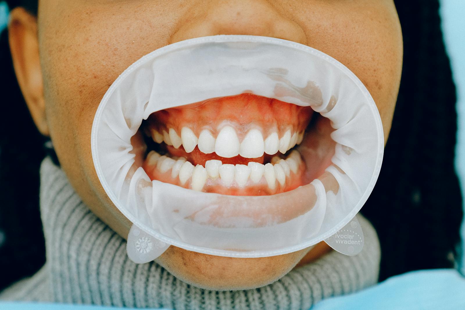 Periodontitis Treatment