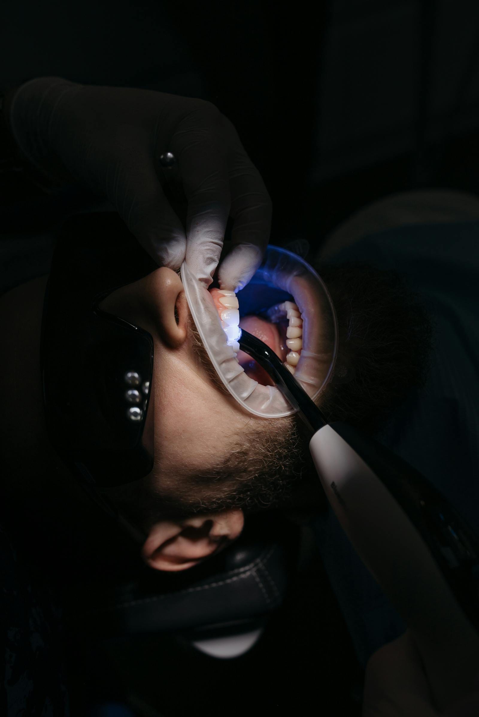 Dental Filling (European)